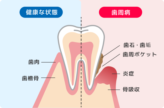 健康な状態の歯と歯周病の歯の違い