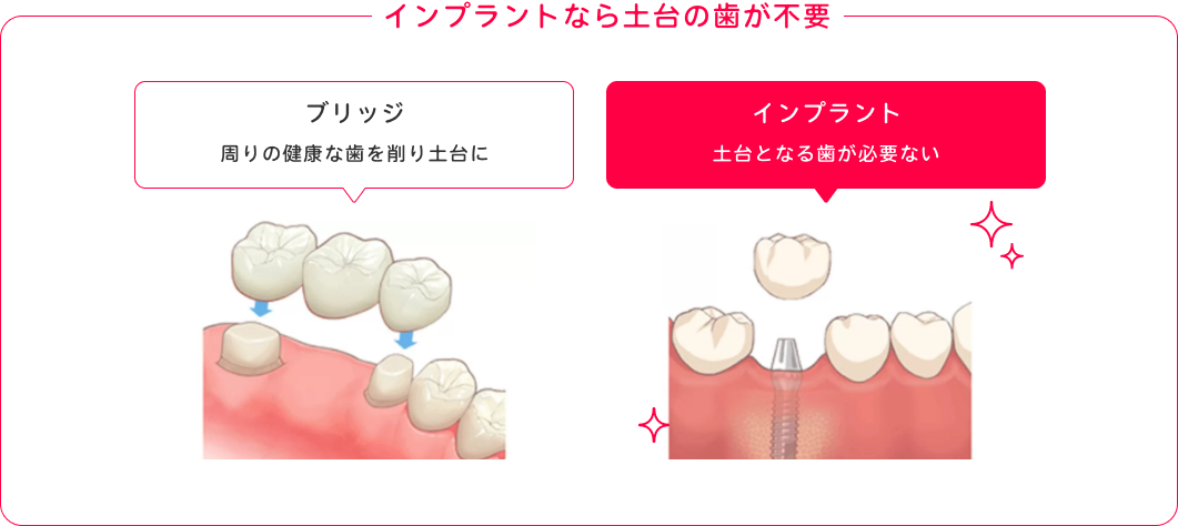 インプラントなら土台の歯が不要