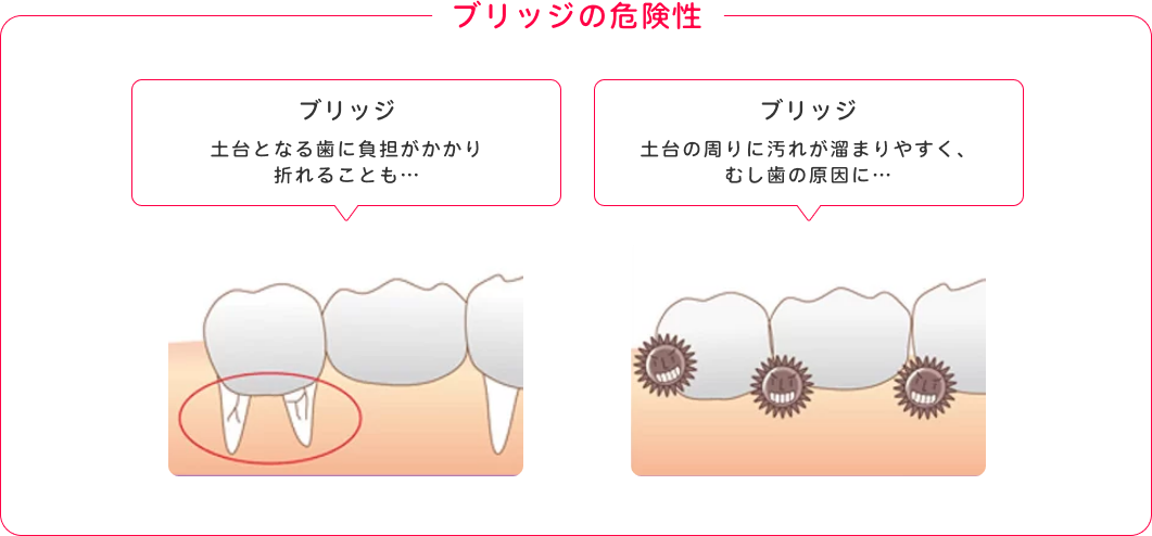 ブリッジの危険性