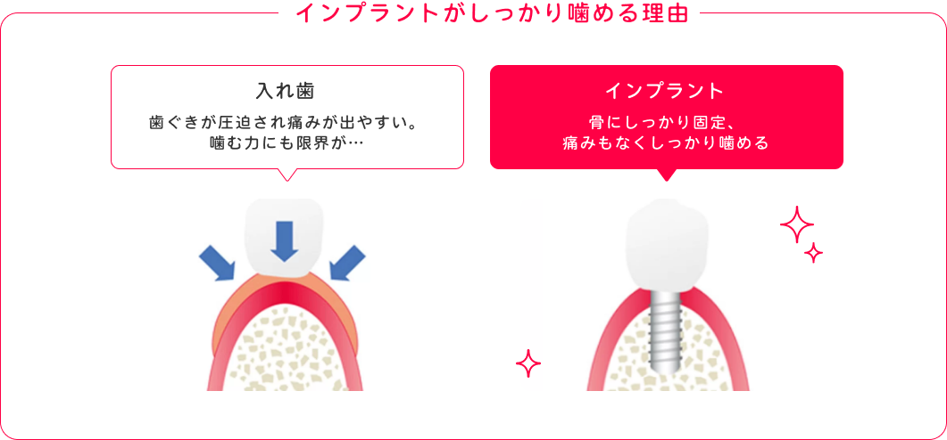 インプラントがしっかり噛める理由