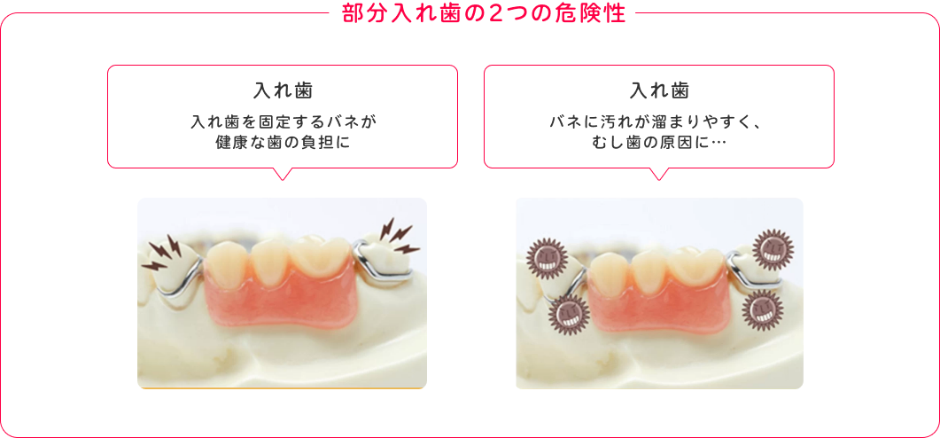 部分入れ歯の2つの危険性